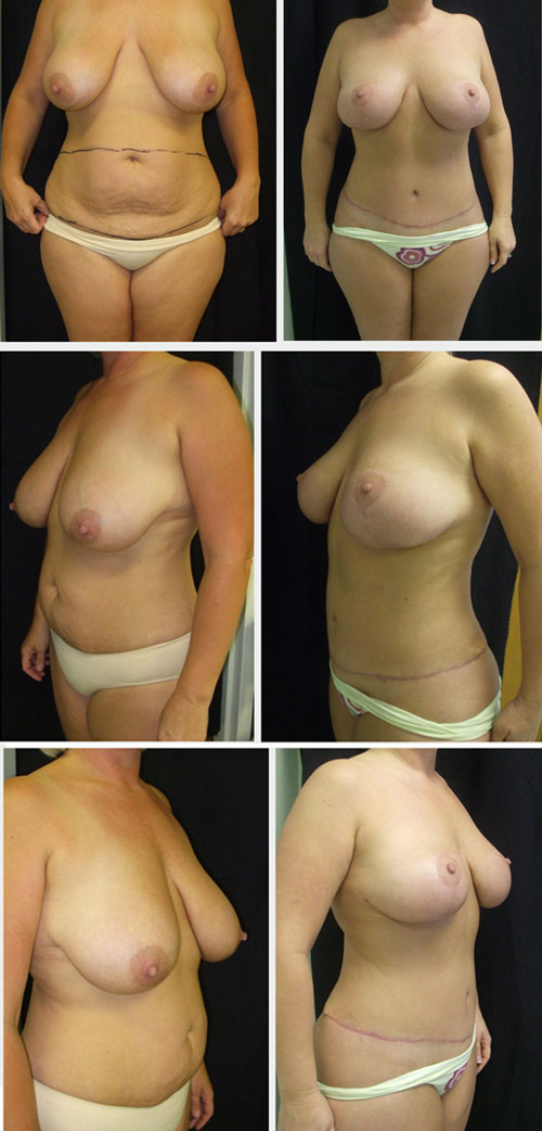 breast lift before and after. and a reast lift.
